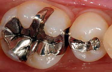 虫歯治療インレー写真